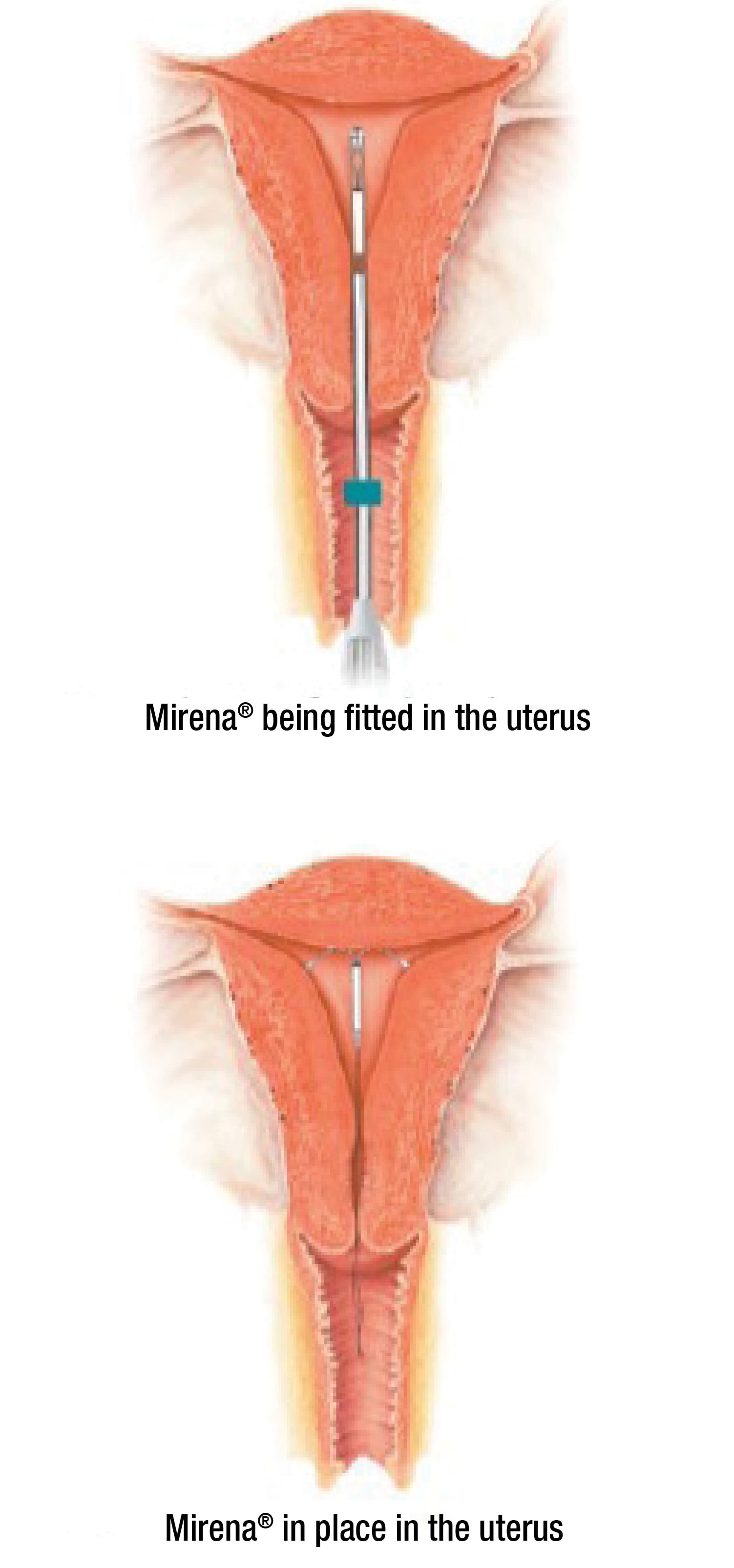 mirena mirena